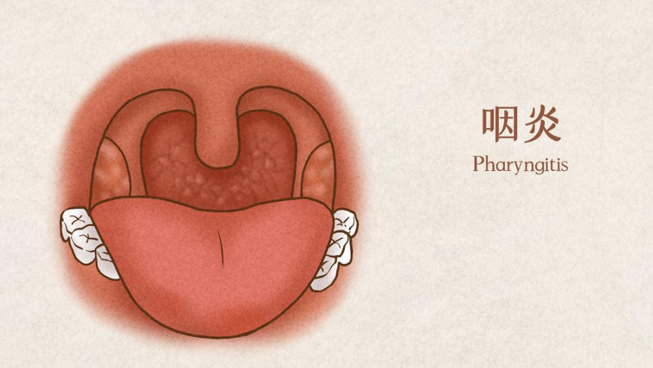 咽炎