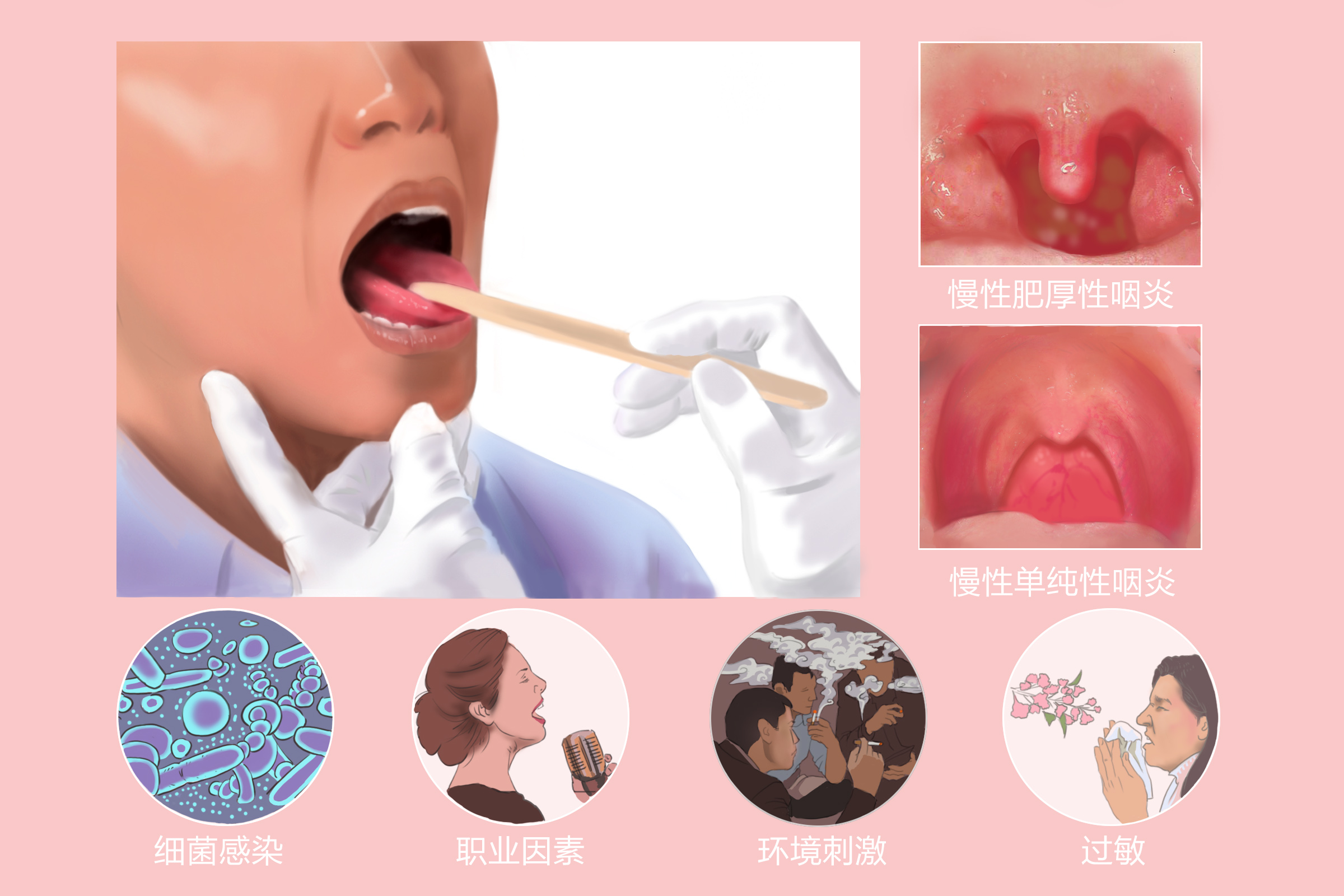 重庆治疗慢性咽炎的医院